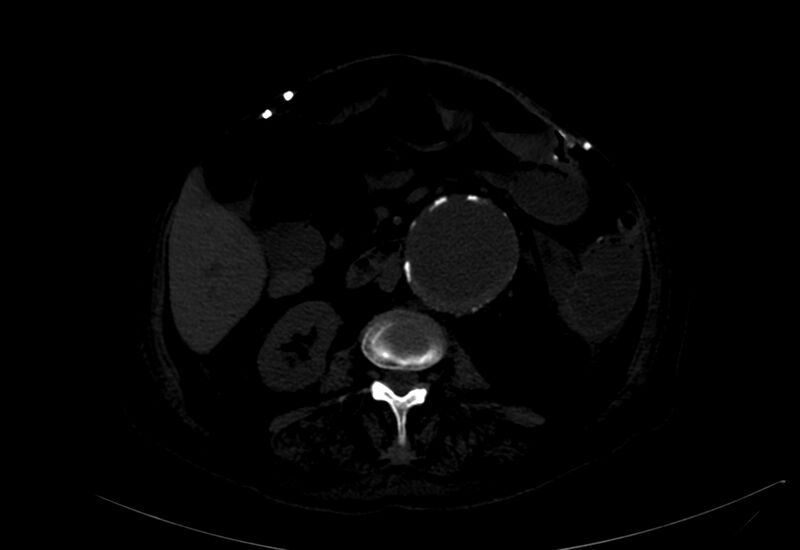 File:Abdominal aortic aneurysm - impending rupture (Radiopaedia 19233-19246 B 15).jpg