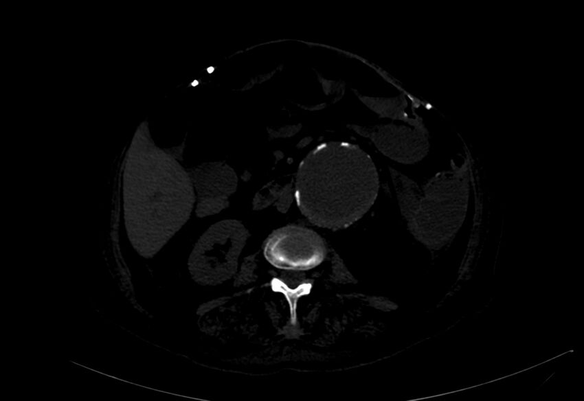 Abdominal aortic aneurysm - impending rupture (Radiopaedia 19233-19246 B 15).jpg