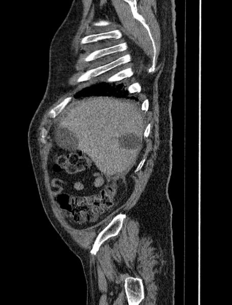 File:Abdominal aortic aneurysm rupture (Radiopaedia 54179-60362 Sagittal C+ arterial phase 3).jpg