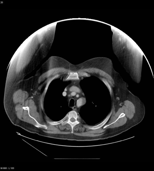 File:Abdominal aortic aneurysm with intramural hematoma then rupture (Radiopaedia 50278-55631 Axial C+ arterial phase 11).jpg