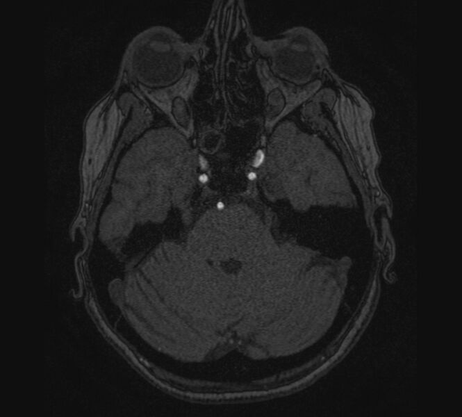 File:Accessory middle cerebral artery and ICA aneurysm (Radiopaedia 22656-22674 MRA 19).jpg