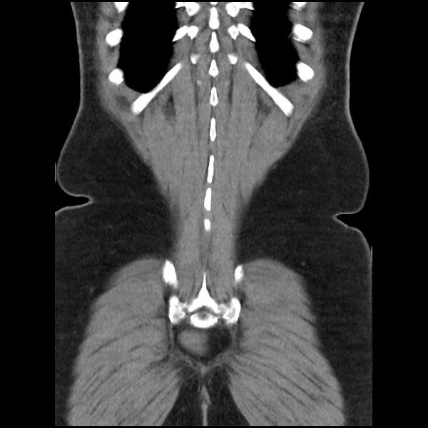 File:Active colonic bleed on CT (Radiopaedia 49765-55025 Coronal non-contrast 48).jpg