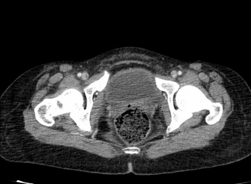 File:Acute Budd-Chiari syndrome (Radiopaedia 60858-68638 Axial C+ portal venous phase 291).jpg
