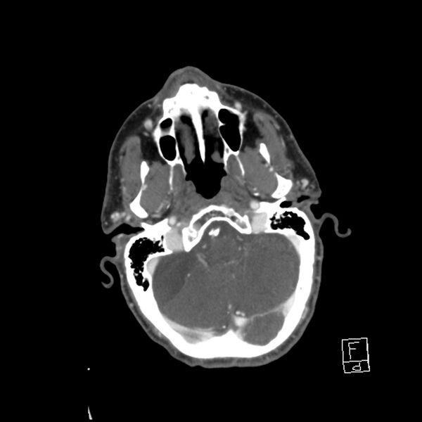 File:Acute ICA ischemic penumbra due to high-grade CCA stenosis (CT perfusion) (Radiopaedia 72038-82530 Axial C+ arterial phase 20).jpg