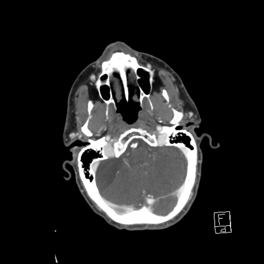 Acute ICA ischemic penumbra due to high-grade CCA stenosis (CT perfusion) (Radiopaedia 72038-82530 Axial C+ arterial phase 20).jpg