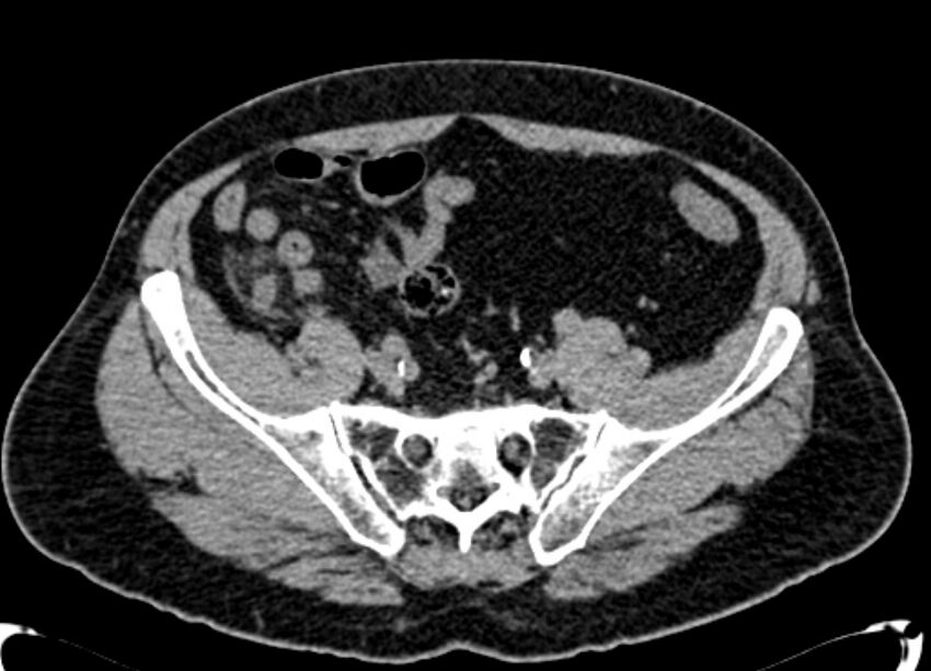 Acute appendicitis (Radiopaedia 13030-13091 Axial non-contrast 43).jpg