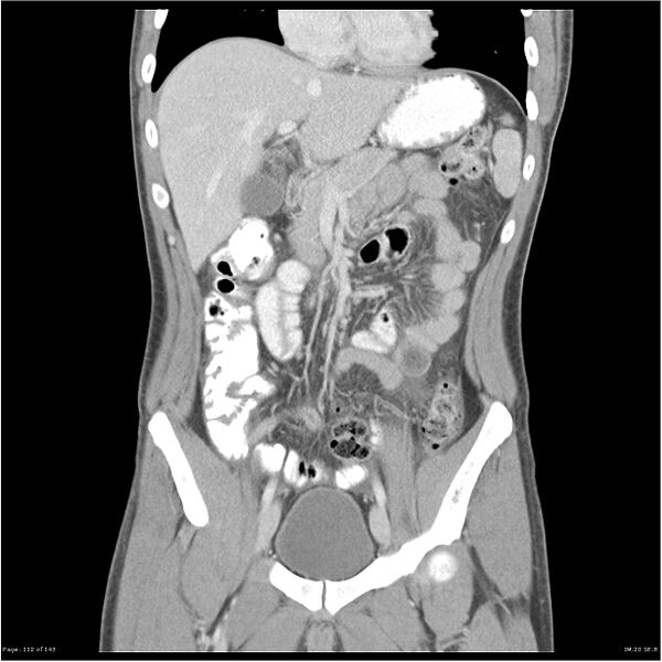 File:Acute appendicitis (Radiopaedia 25364-25615 C+ portal venous phase 9).jpg