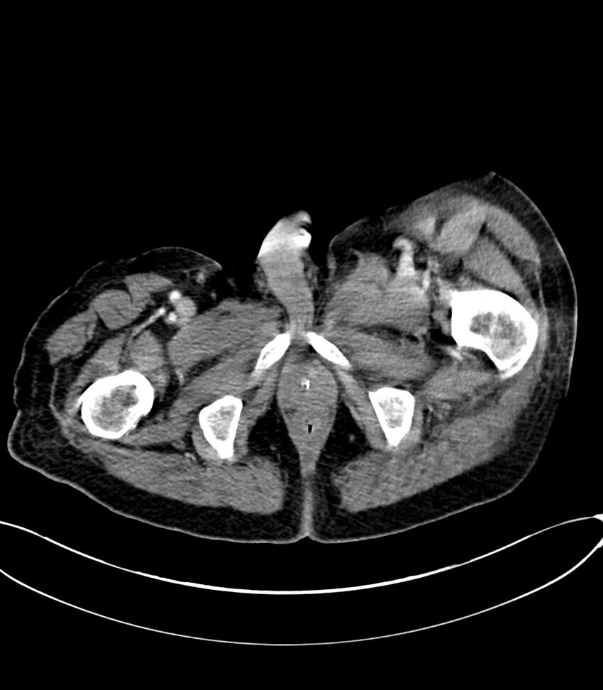Acute arterial mesenteric ischemia (Radiopaedia 78238-90828 Axial C+ portal venous phase 150).jpg