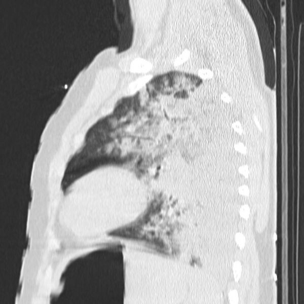 File:Acute aspiration pneumonitis (Radiopaedia 33605-34703 Sagittal lung window 63).jpg