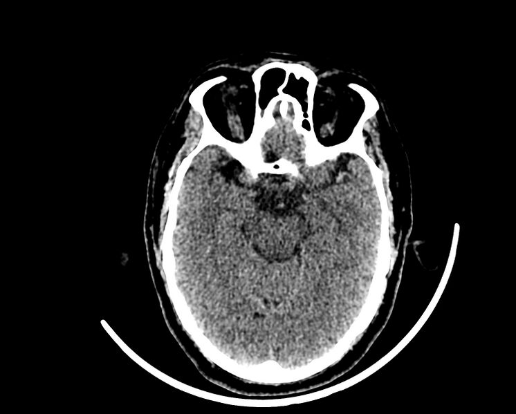 File:Acute cerebral infarct (Radiopaedia 35604-37123 Axial non-contrast 38).jpg