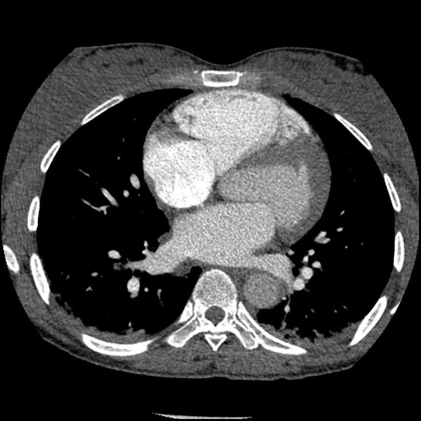 Acute chest syndrome - sickle cell disease (Radiopaedia 42375-45499 Axial C+ CTPA 108).jpg