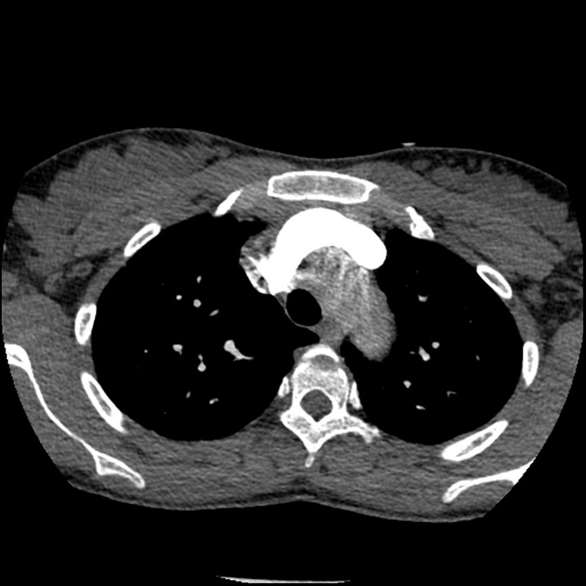 Acute chest syndrome - sickle cell disease (Radiopaedia 42375-45499 Axial C+ CTPA 48).jpg