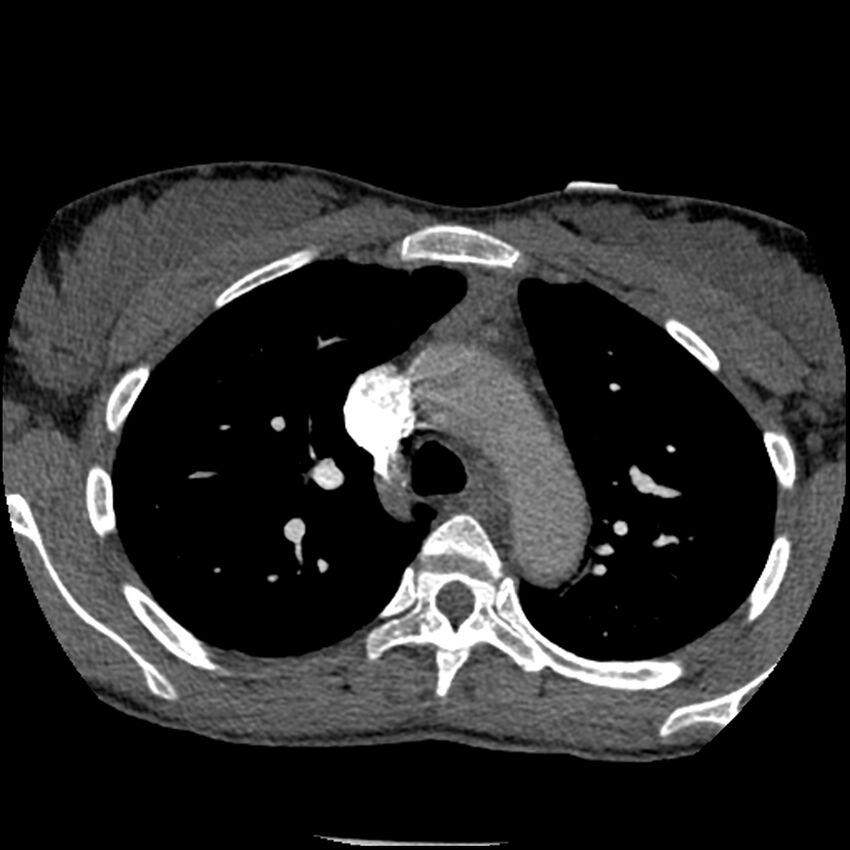 Acute chest syndrome - sickle cell disease (Radiopaedia 42375-45499 Axial C+ CTPA 59).jpg