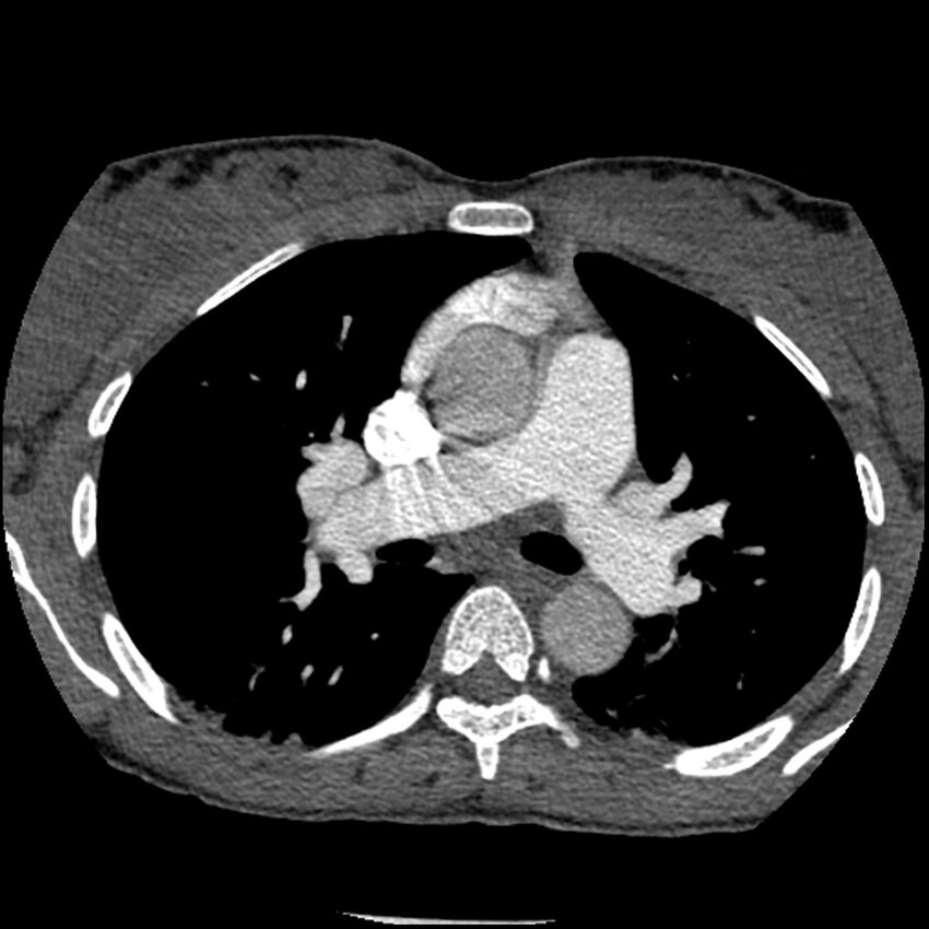 Acute chest syndrome - sickle cell disease (Radiopaedia 42375-45499 Axial C+ CTPA 80).jpg