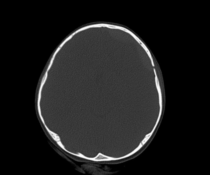 File:Acute epidural hematoma (Radiopaedia 63659-72335 Axial bone window 14).jpg