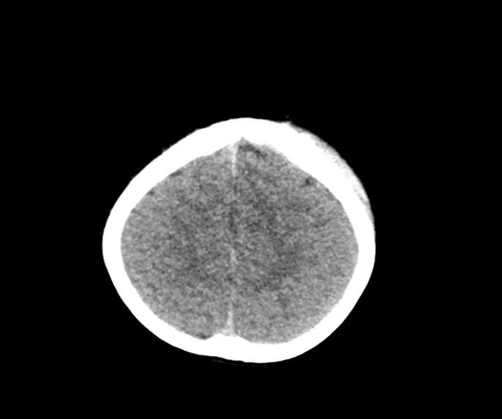 File:Acute epidural hematoma (Radiopaedia 63659-72335 Axial non-contrast 22).jpg