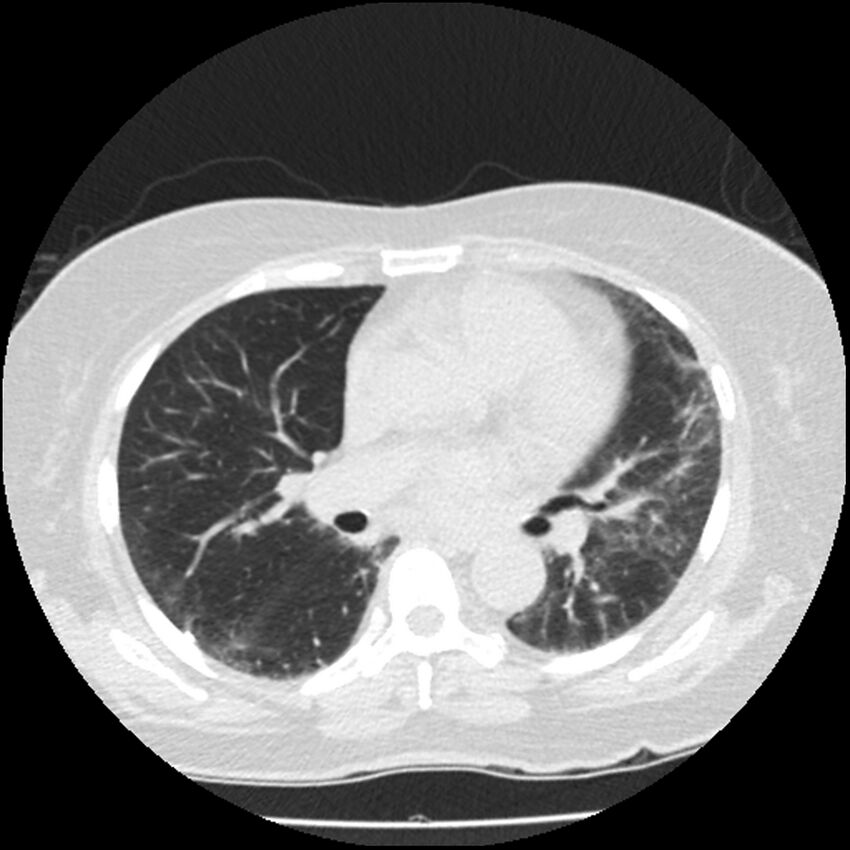 Acute interstitial pneumonitis (Radiopaedia 45404-49444 Axial lung window 54).jpg