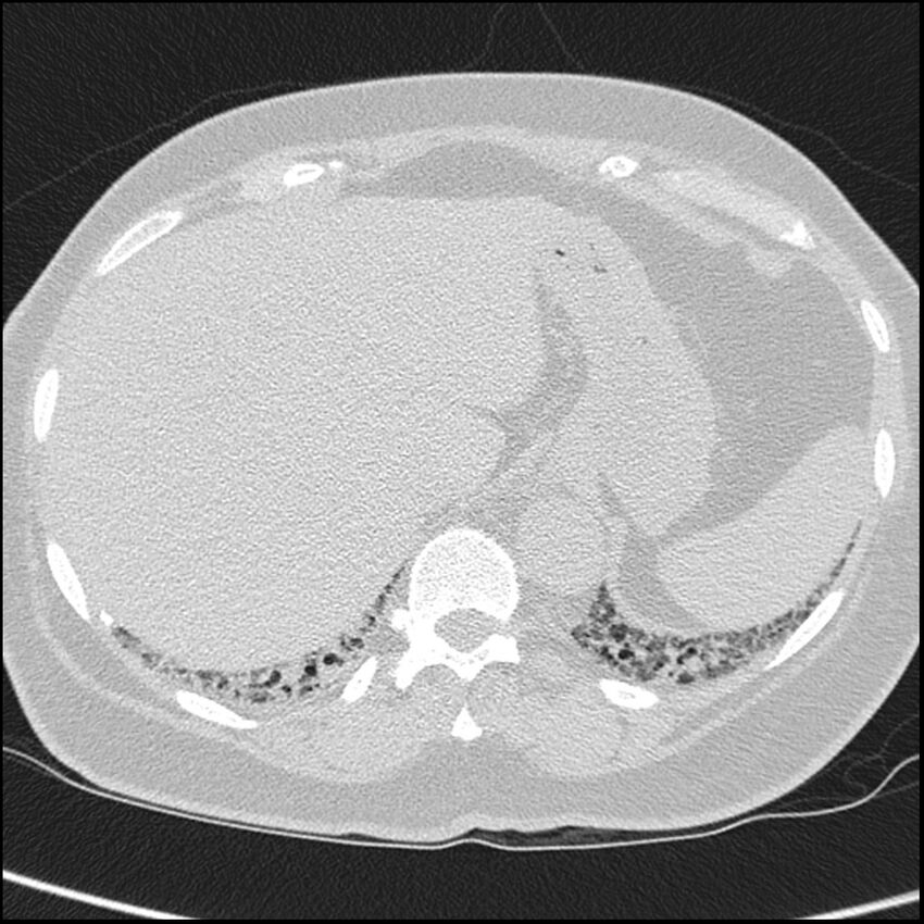 Acute interstitial pneumonitis (Radiopaedia 45404-49453 Axial lung window 71).jpg