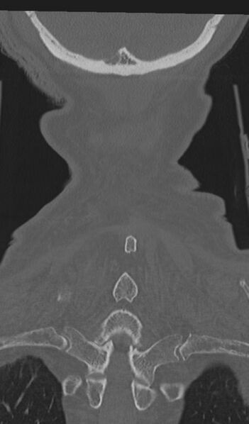 File:Acute on chronic subdural hematoma and thoracic vertebral injury in a multitrauma patient (Radiopaedia 31698-32619 Coronal bone window 62).jpg