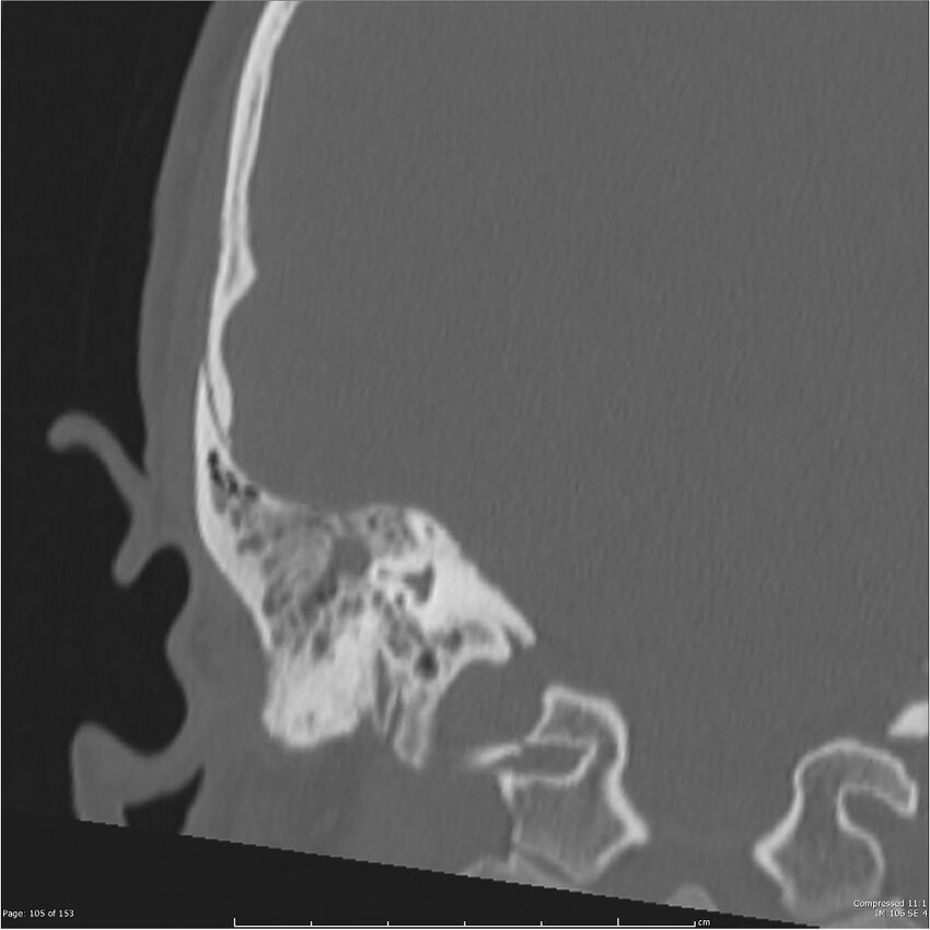 Acute otomastoiditis (Radiopaedia 28276-28512 Coronal PTB bone window reformat 36).jpg