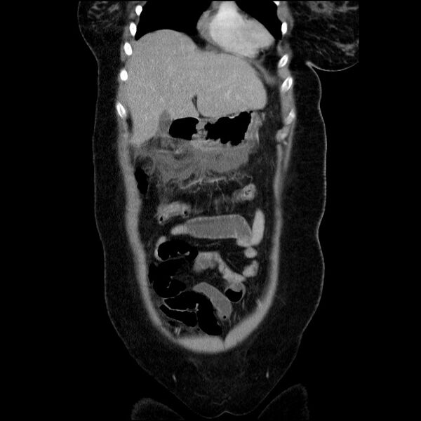File:Acute pancreatitis (Radiopaedia 69236-79012 Coronal C+ portal venous phase 56).jpg