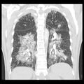 Acute pulmonary edema on CT (Radiopaedia 33582-34672 Coronal lung window 27).jpg