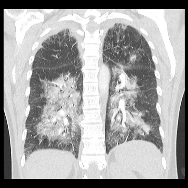 File:Acute pulmonary edema on CT (Radiopaedia 33582-34672 Coronal lung window 27).jpg