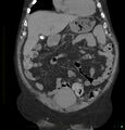 Acute renal failure post IV contrast injection- CT findings (Radiopaedia 47815-52557 Coronal non-contrast 11).jpg
