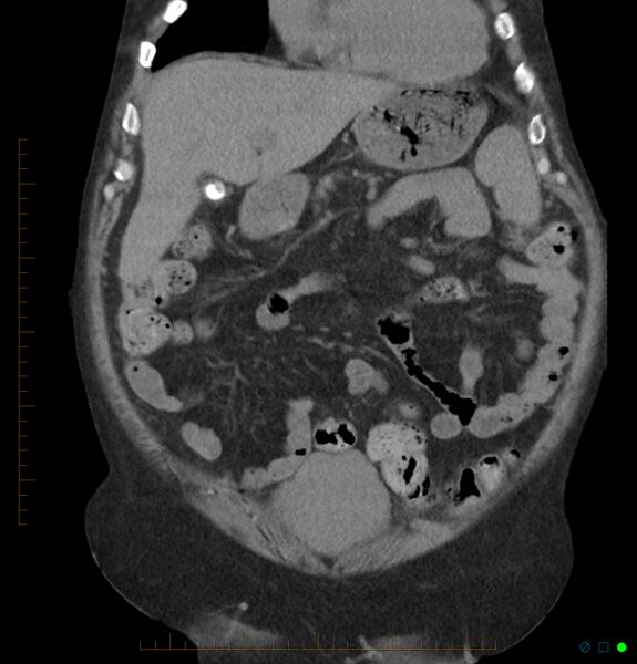 File:Acute renal failure post IV contrast injection- CT findings (Radiopaedia 47815-52557 Coronal non-contrast 11).jpg
