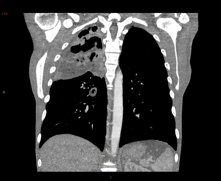 File:Acute right lung abscess (Radiopaedia 34806-36258 Coronal C+ arterial phase 17).jpg