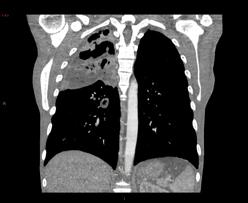 Acute right lung abscess (Radiopaedia 34806-36258 Coronal C+ arterial phase 17).jpg