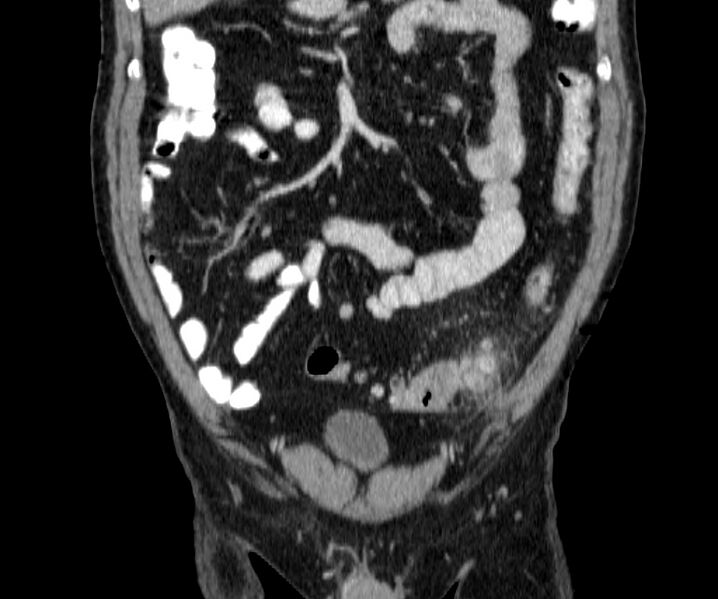 File:Acute sigmoid colon diverticulitis (Radiopaedia 55507-61976 Coronal C+ portal venous phase 38).jpg