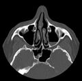 Acute sinusitis (Radiopaedia 23161-23215 Axial bone window 32).jpg