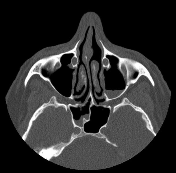 File:Acute sinusitis (Radiopaedia 23161-23215 Axial bone window 32).jpg