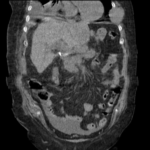 File:Acute tubular necrosis (Radiopaedia 28077-28334 D 35).jpg