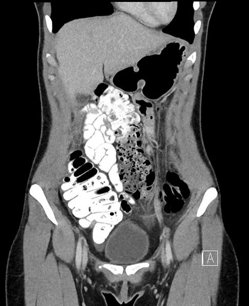 File:Acute uncomplicated appendicitis (Radiopaedia 61374-69304 Coronal C+ portal venous phase 25).jpg