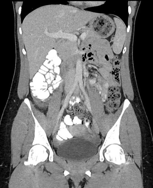 File:Acute uncomplicated appendicitis (Radiopaedia 61374-69304 Coronal C+ portal venous phase 47).jpg