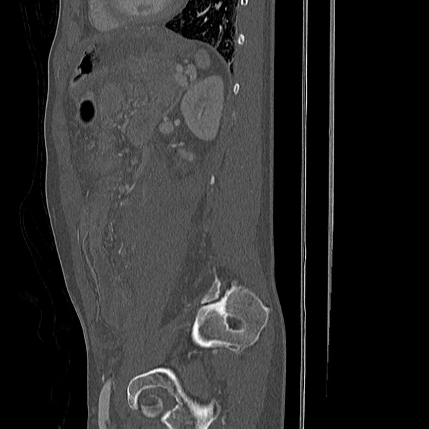 Acute vertebral body compression fractures (Radiopaedia 31757-32693 Sagittal bone window 2).jpg