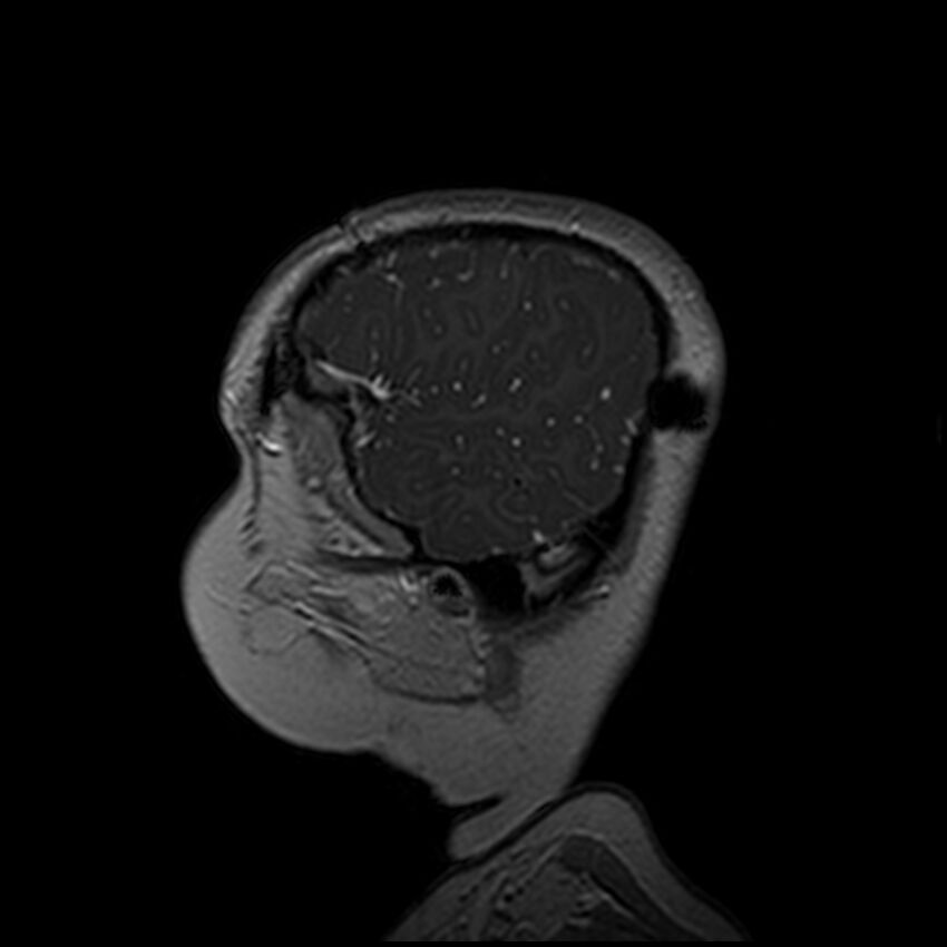 Adamantinomatous craniopharyngioma (Radiopaedia 77407-89529 H 107).jpg