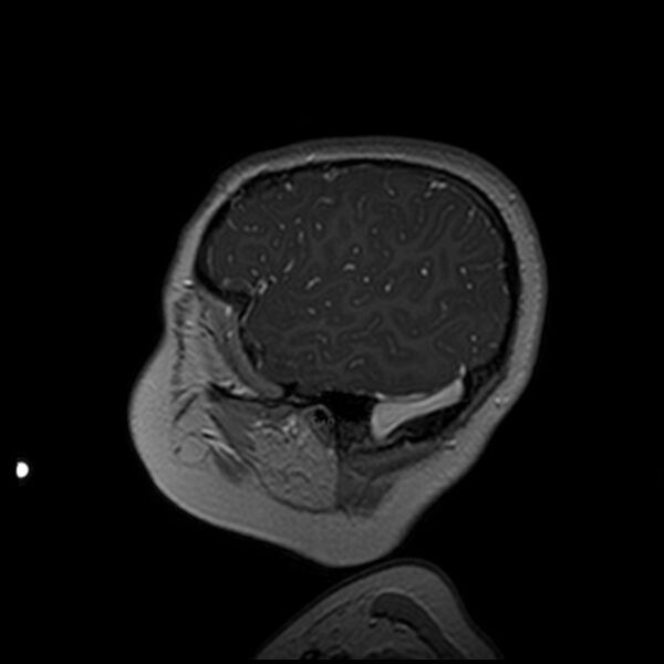 File:Adamantinomatous craniopharyngioma (Radiopaedia 77407-89529 H 18).jpg
