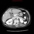 Adenocarcinoma of the colon (Radiopaedia 8191-9039 Axial liver window 26).jpg