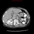 Adenocarcinoma of the colon (Radiopaedia 8191-9039 Axial renal excretory phase 11).jpg