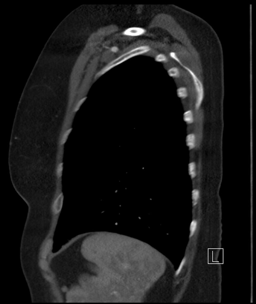 Adenocarcinoma of the lung (Radiopaedia 44205-47803 Sagittal C+ portal venous phase 10).jpg