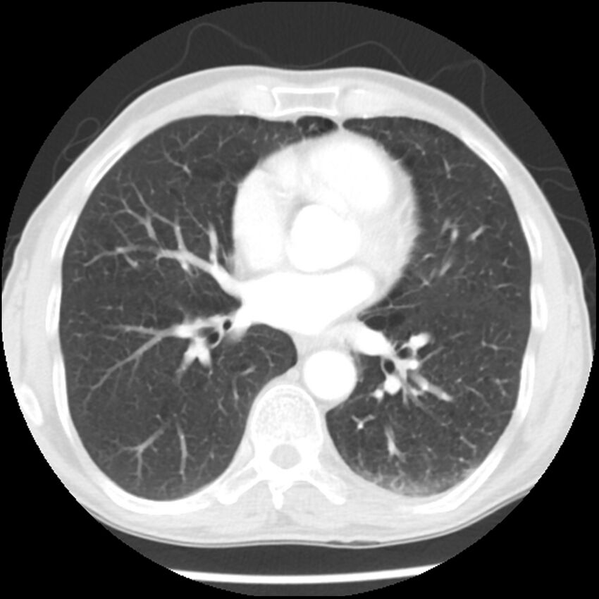 Adenocarcinoma of the lung - micropapillary predominant (Radiopaedia 42446-45563 Axial lung window 43).jpg