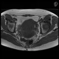 Adenoma malignum of the cervix (Radiopaedia 24460-24765 T1 11).jpg