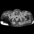 Adenomyoma of the uterus (huge) (Radiopaedia 9870-10438 Axial T1 fat sat 6).jpg