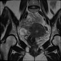 Adenomyosis and endometriotic cysts (Radiopaedia 82300-96367 Coronal T2 22).jpg