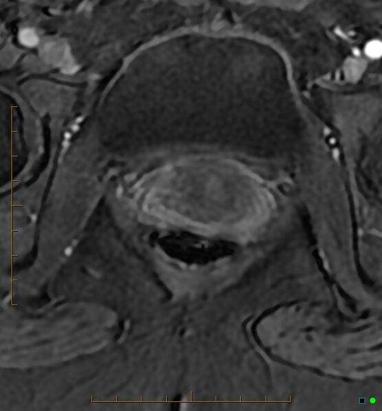 File:Adenomyosis uterus with hematometra (Radiopaedia 45779-50011 Axial T1 C+ fat sat 58).jpg