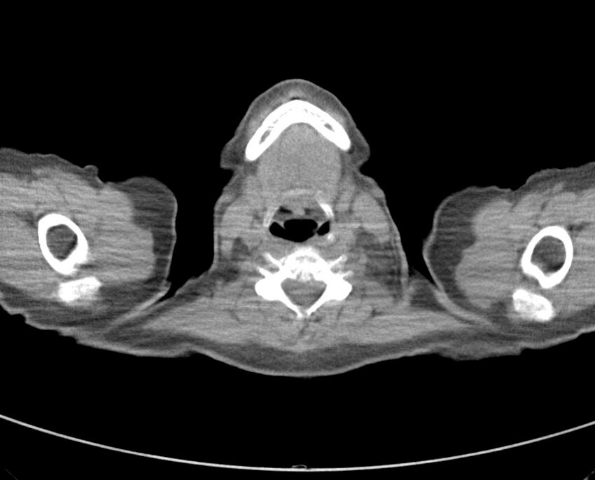 Adenosquamous lung carcinoma (Radiopaedia 22035-22030 non-contrast 3).jpg