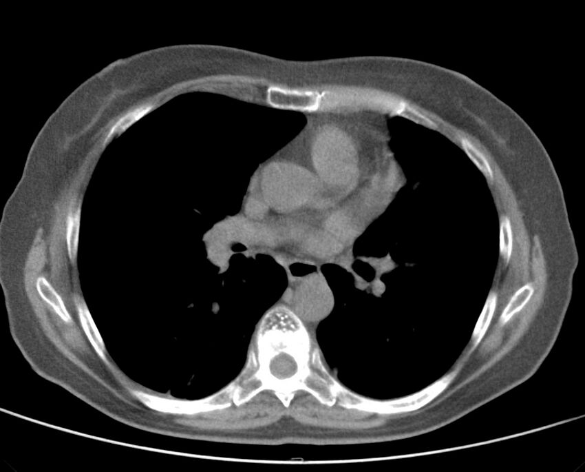 Adenosquamous lung carcinoma (Radiopaedia 22035-22030 non-contrast 33).jpg
